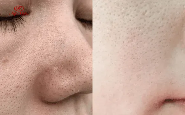 Lỗ chân lông có se khít vĩnh viễn được không?