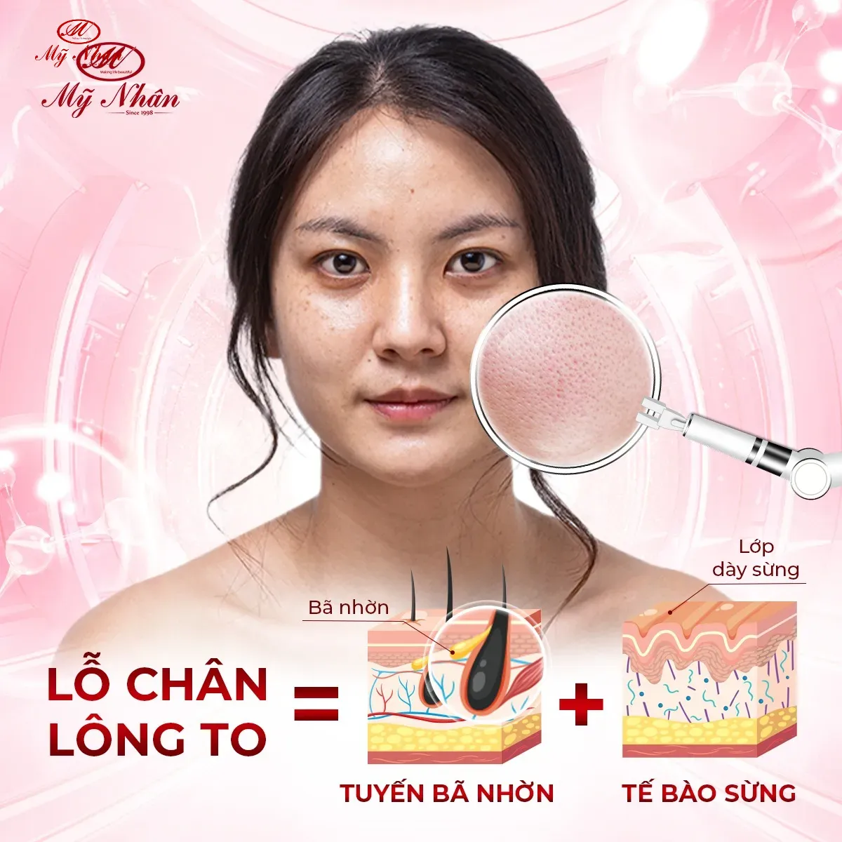 Lỗ chân lông to