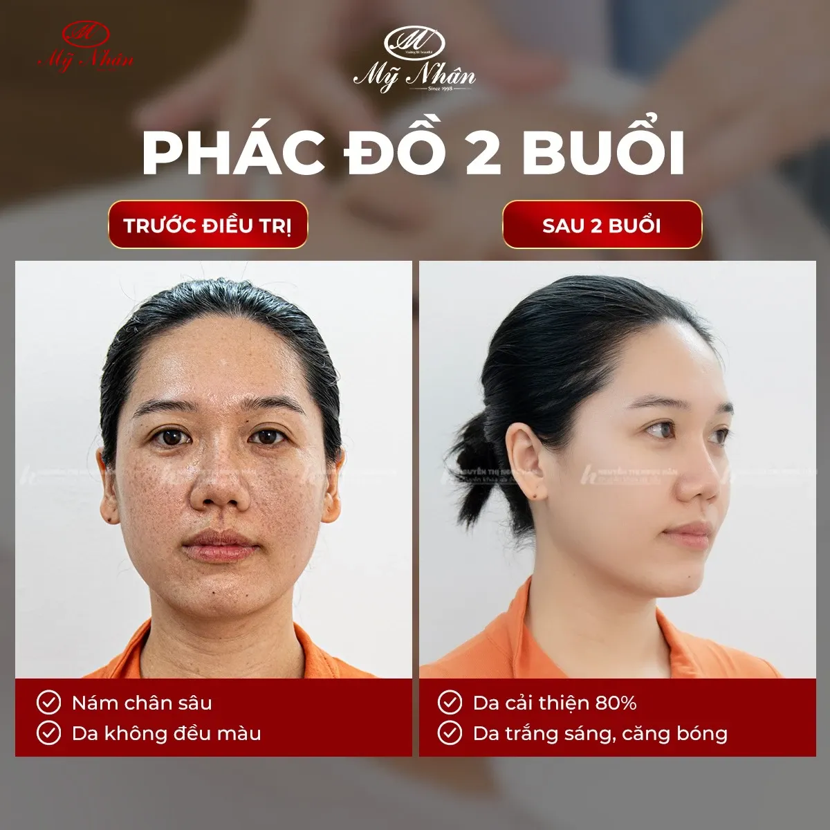 Điều trị nám hiệu quả tại Mỹ Viện Mỹ Nhân