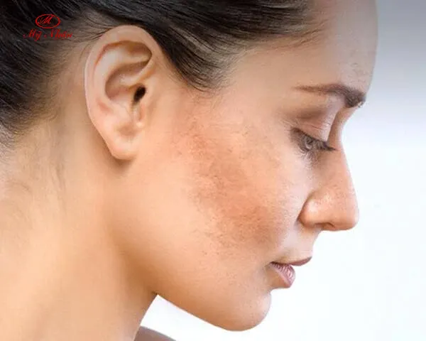 Kiểm tra kỹ hình dáng các vết nám