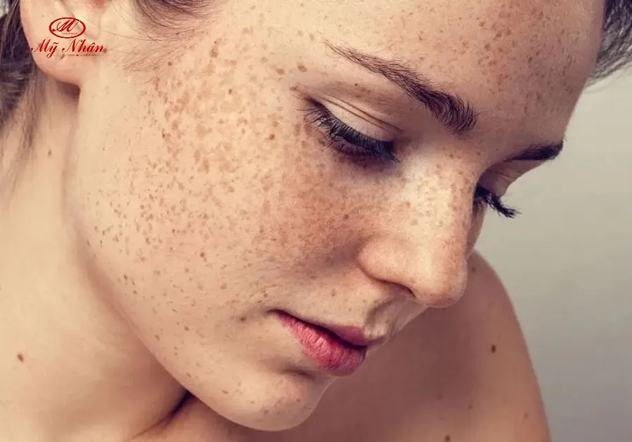 Quan sát màu sắc của vết nám để nhận biết