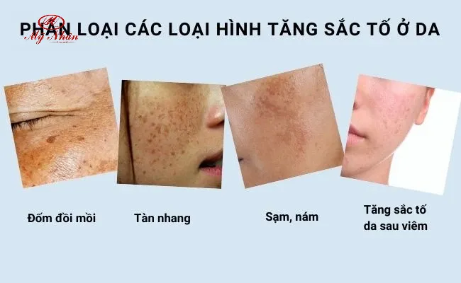 Các loại tăng sắc tố da