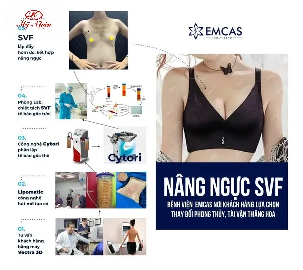 NÂNG NGỰC SVF tại EMCAS