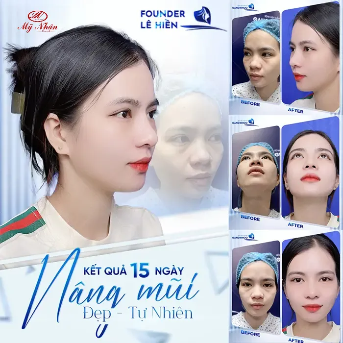 Bệnh viện thẩm mỹ Gangwhoo – Kết quả thẩm mỹ thực tế