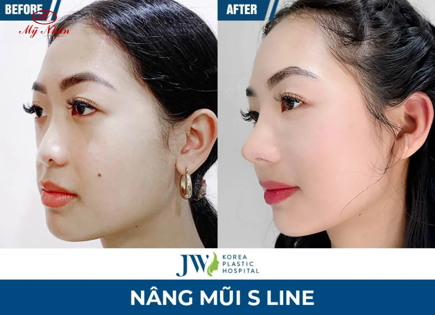 Hình ảnh trước sau của khách hàng Bệnh viện JW