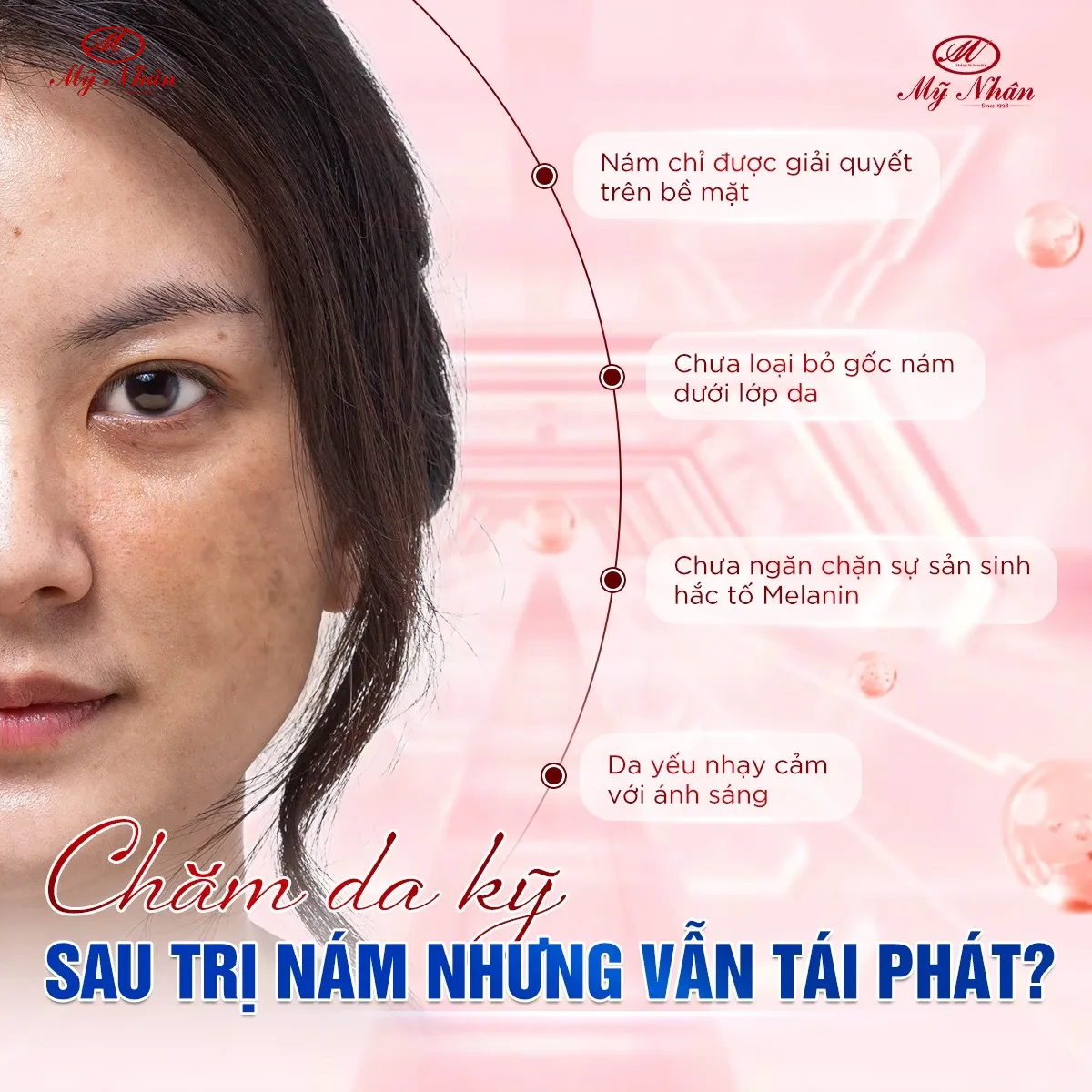 Nám nhưng vẫn tái phát cần làm gì?